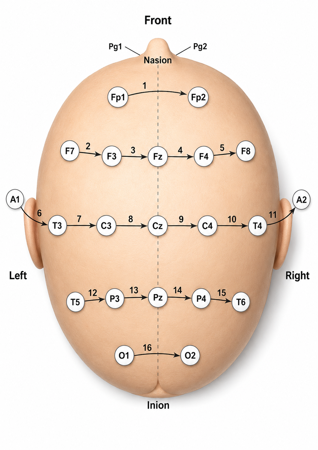 Transverse montage diagram