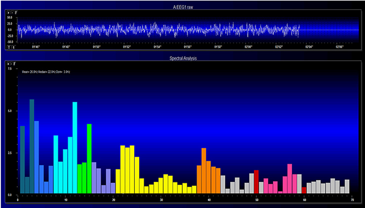 EEG spectrogram