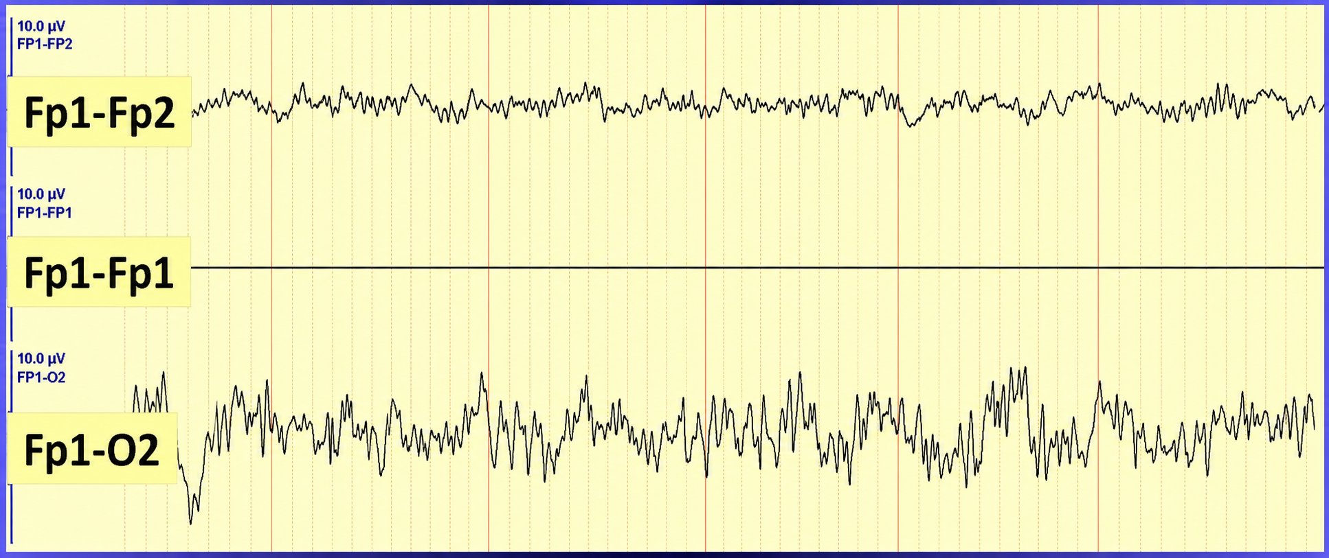 Adjacent electrode cancellation