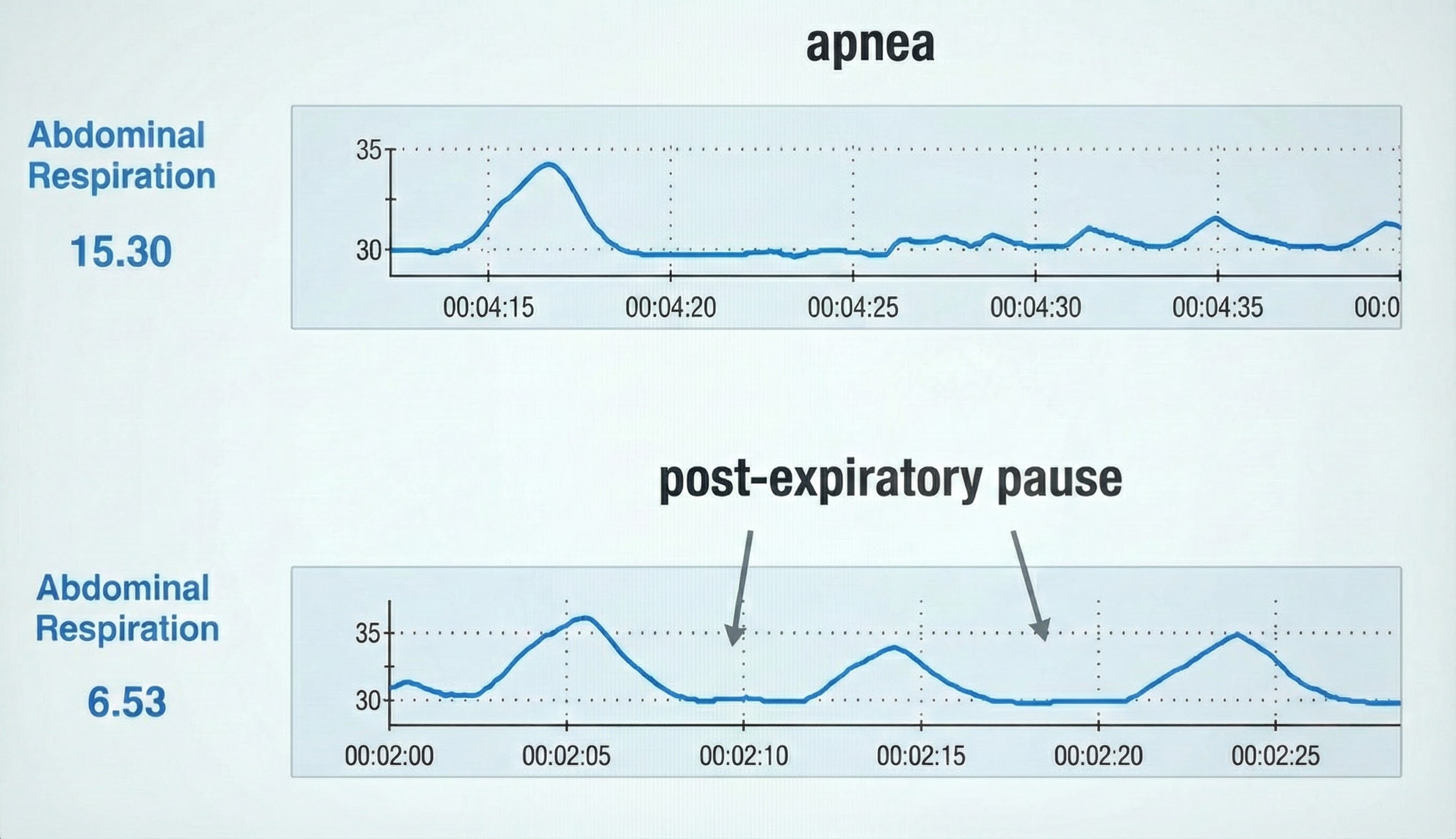 Diagram contrasting apnea with a normal post-expiratory pause in the breathing cycle