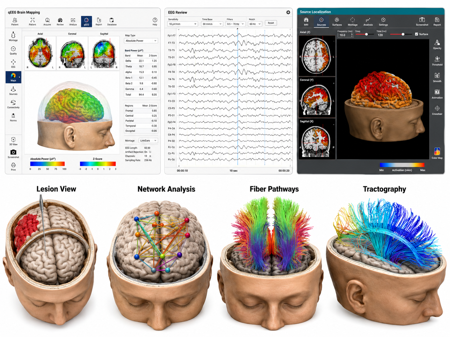 Composite of qEEG software screens - a brain-mapping page with topographic maps and a band power table, a 19-channel EEG review page, and a source-localization page - above four rendered brain views labeled Lesion View, Network Analysis, Fiber Pathways, and Tractography
