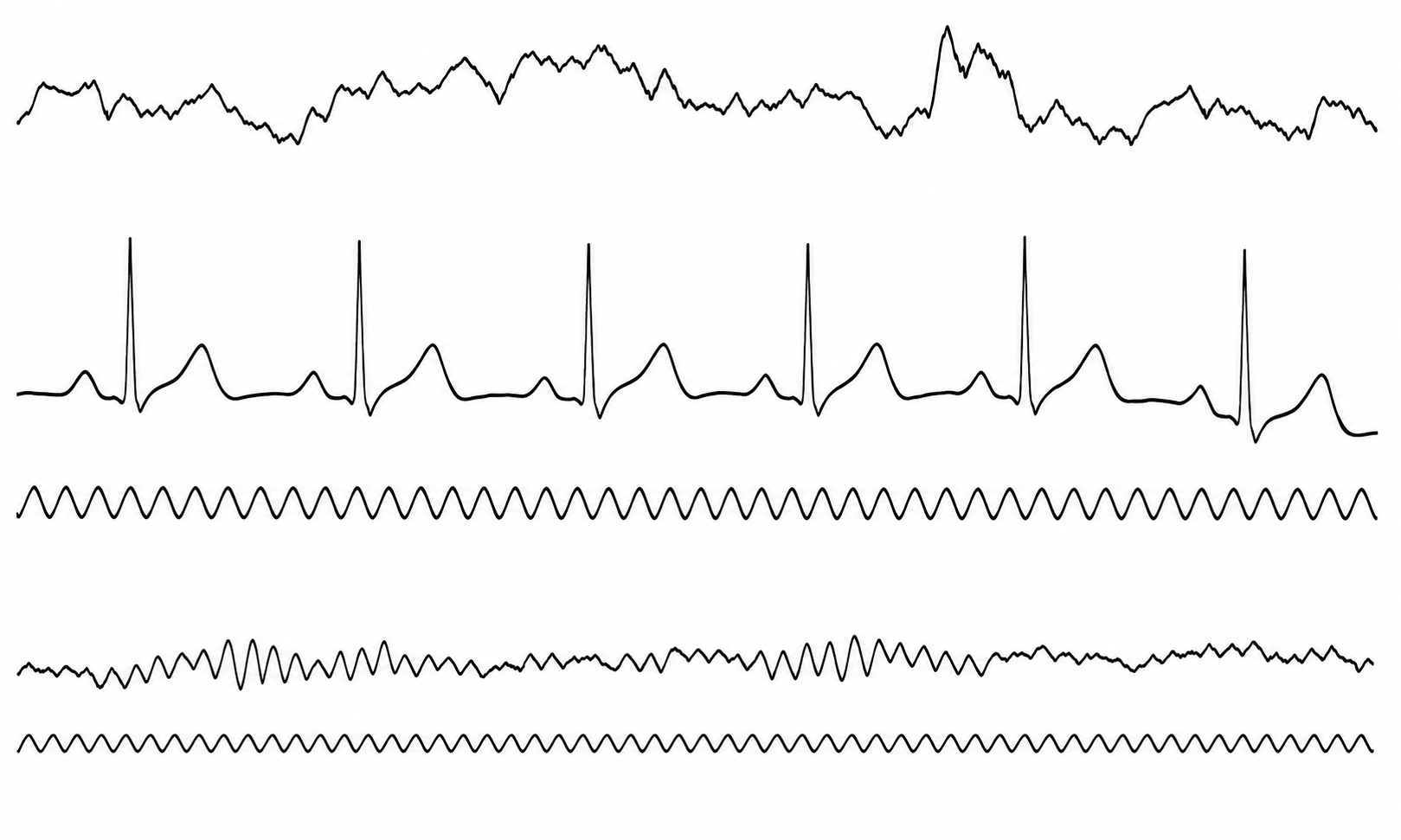 Early EEG recording by Berger
