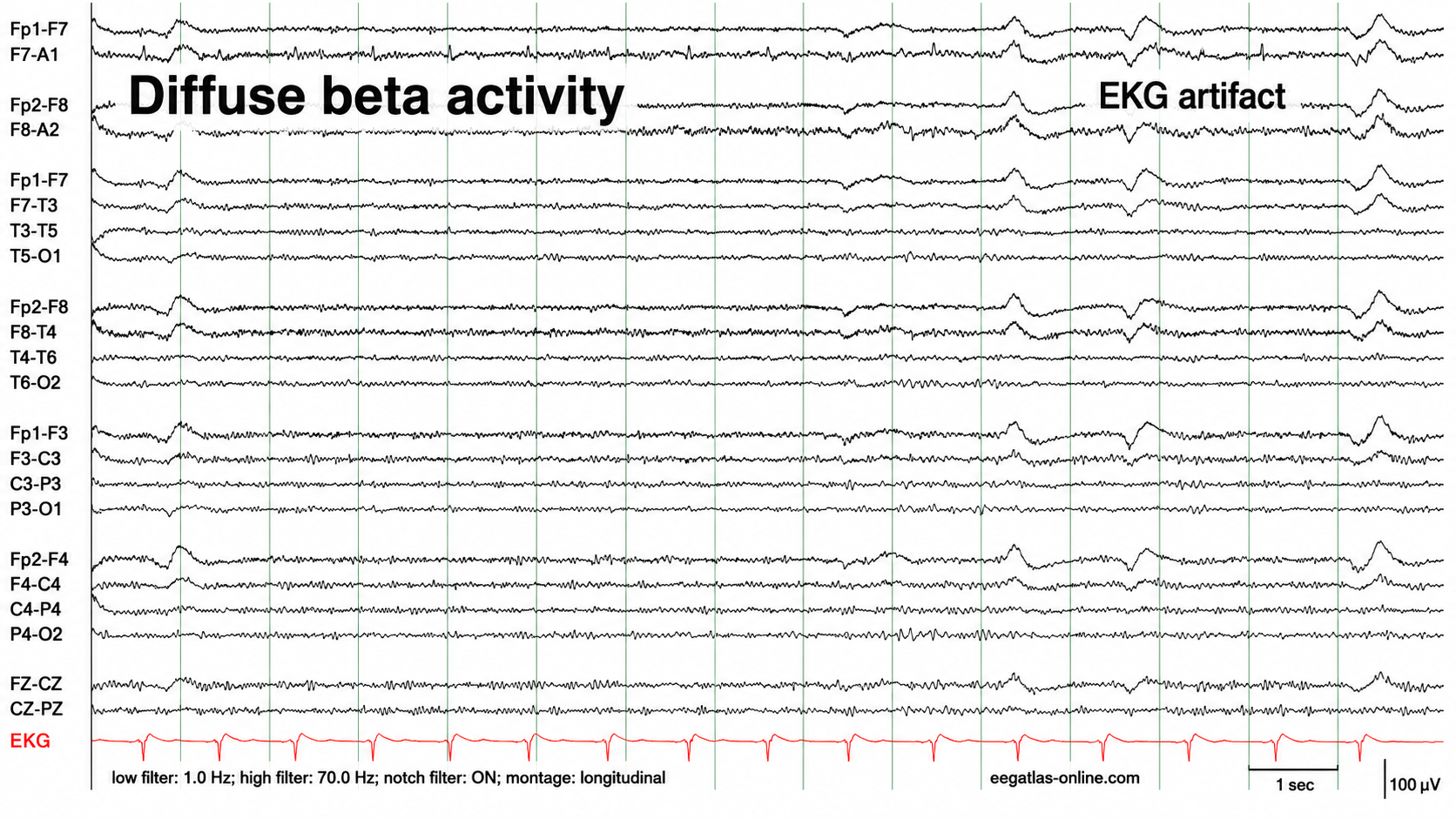 Cardiac artifact in EEG