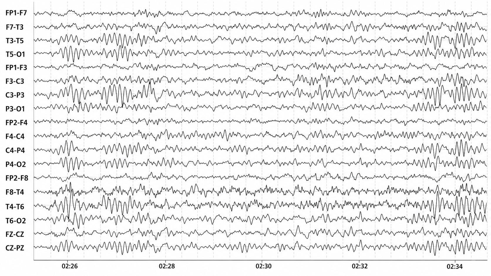 Drowsiness artifact example 1