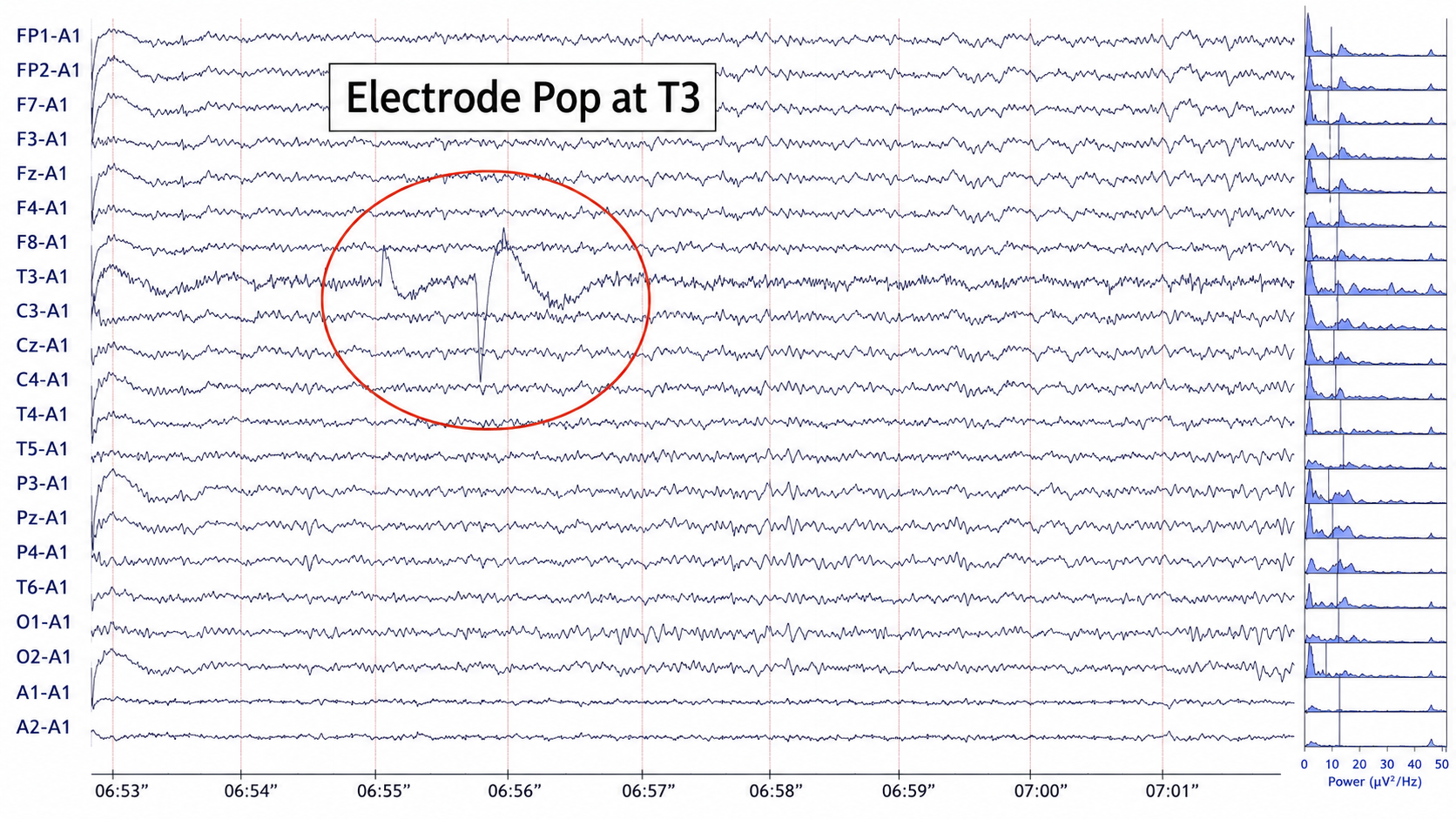 Electrode pop artifact
