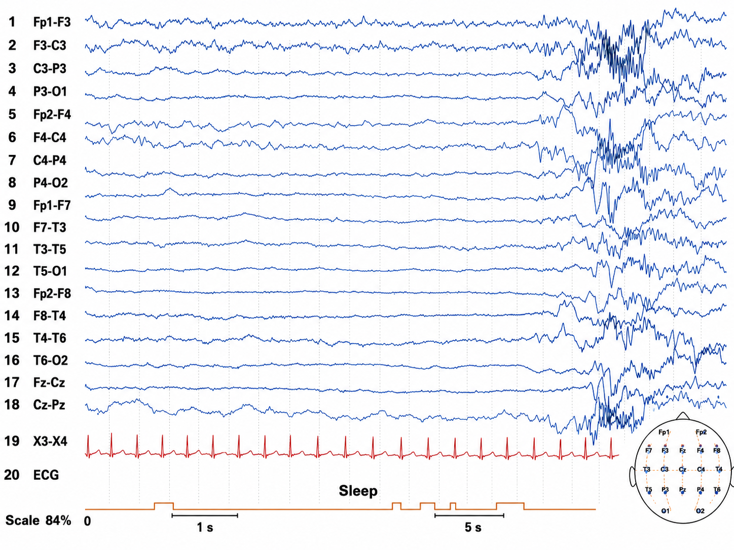 Illustration of pediatric seizure activity