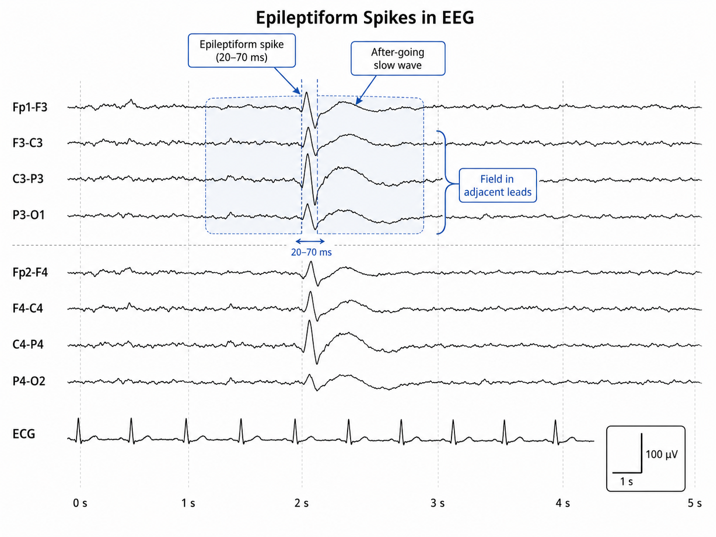 EEG tracing showing sharp epileptiform spike transients standing out from the background rhythm