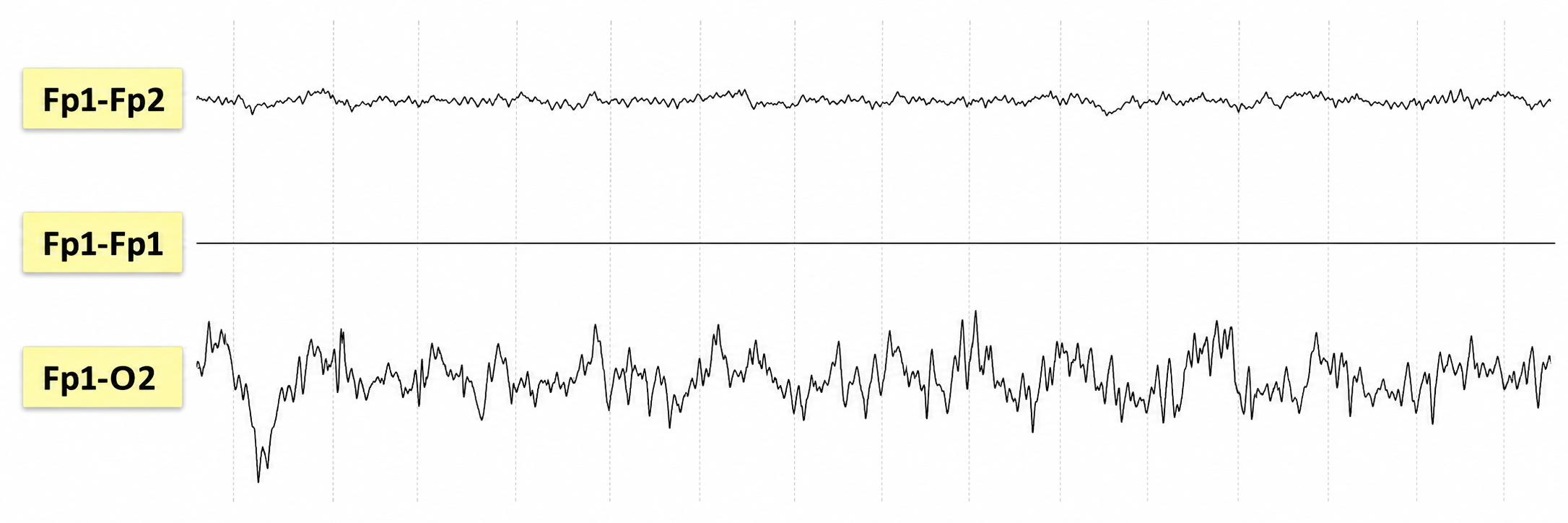 Sequential montage EEG record