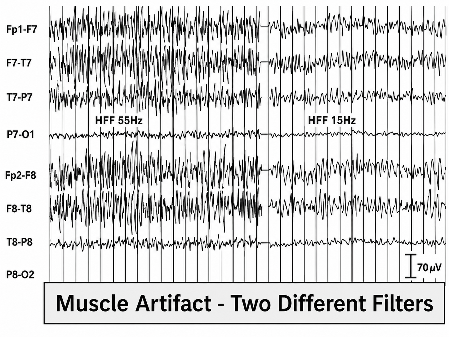SEMG artifact with two different filters