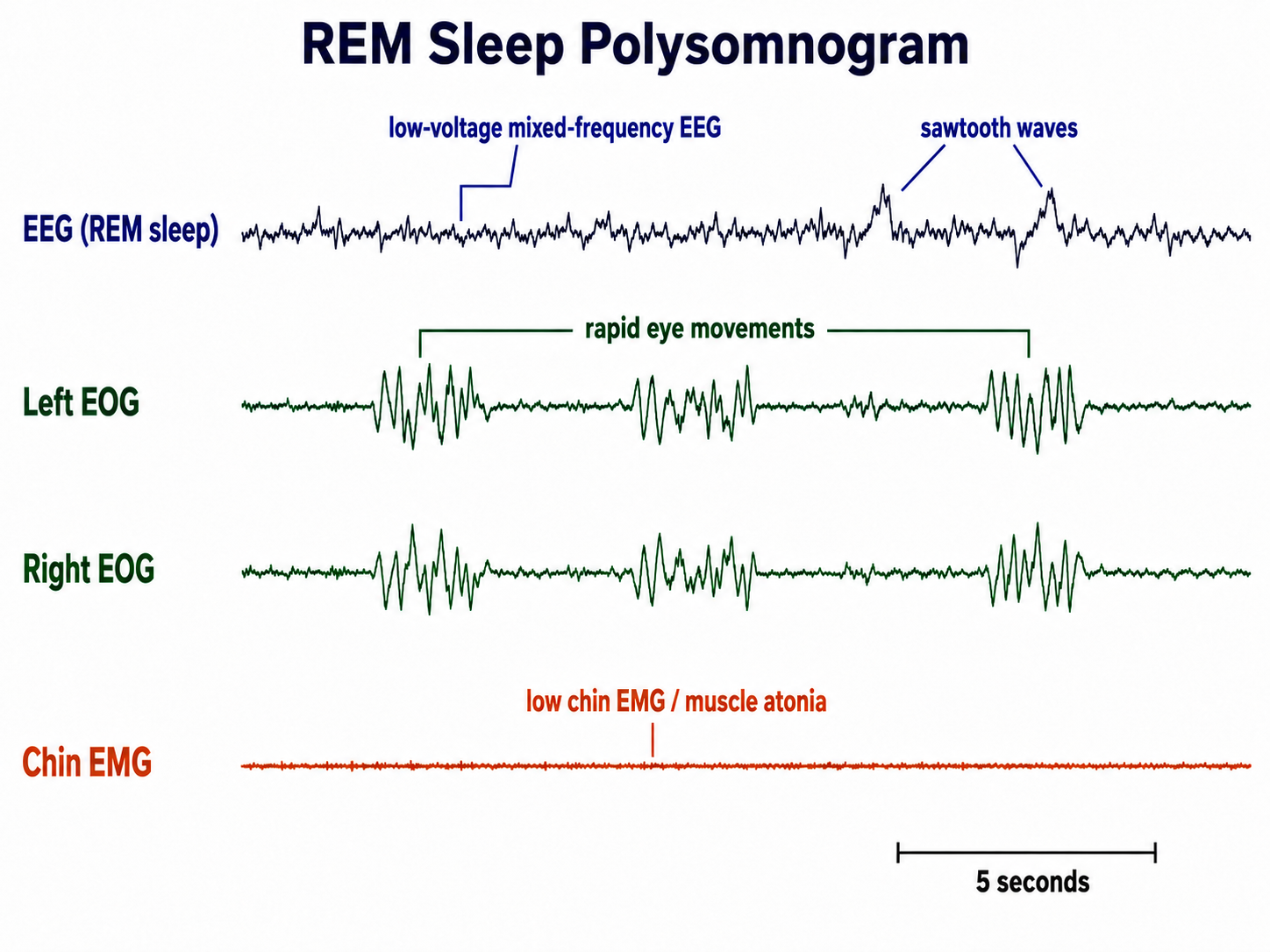 EEG recording during REM sleep