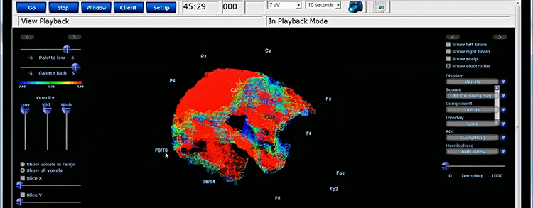 sLORETA brain mapping