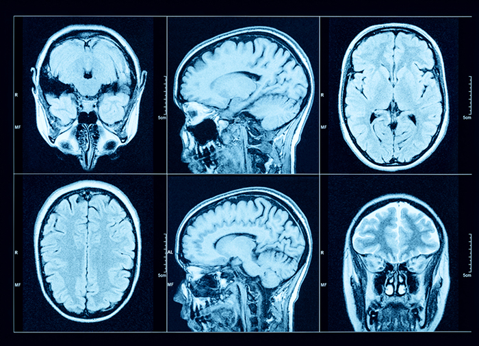 CT brain scan