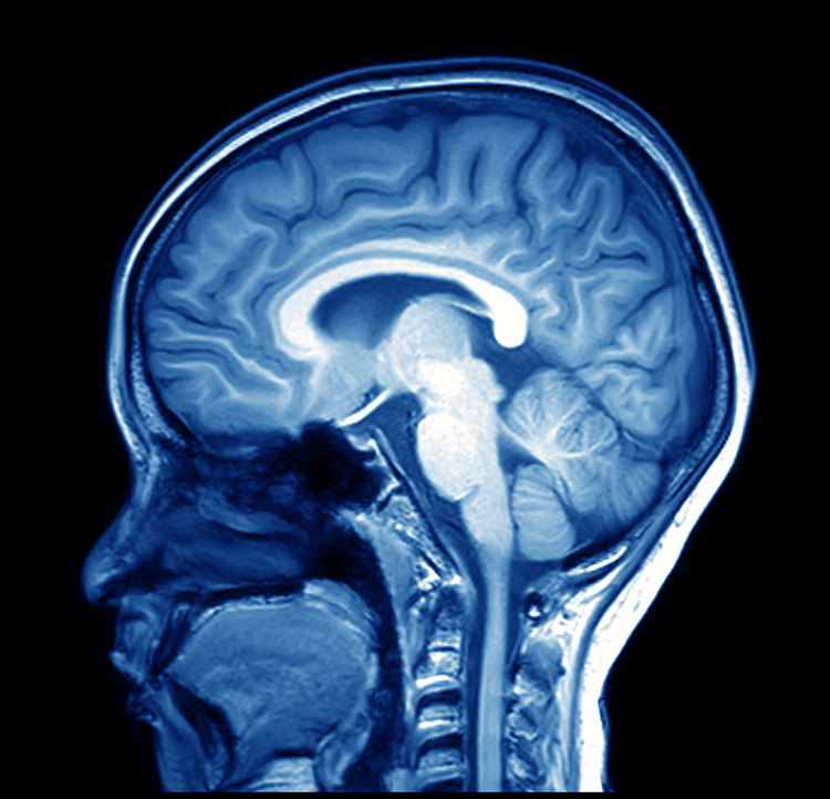 MRI brain scan showing detail