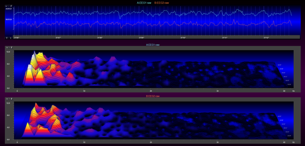 Stage 1 sleep EEG with compressed spectral array