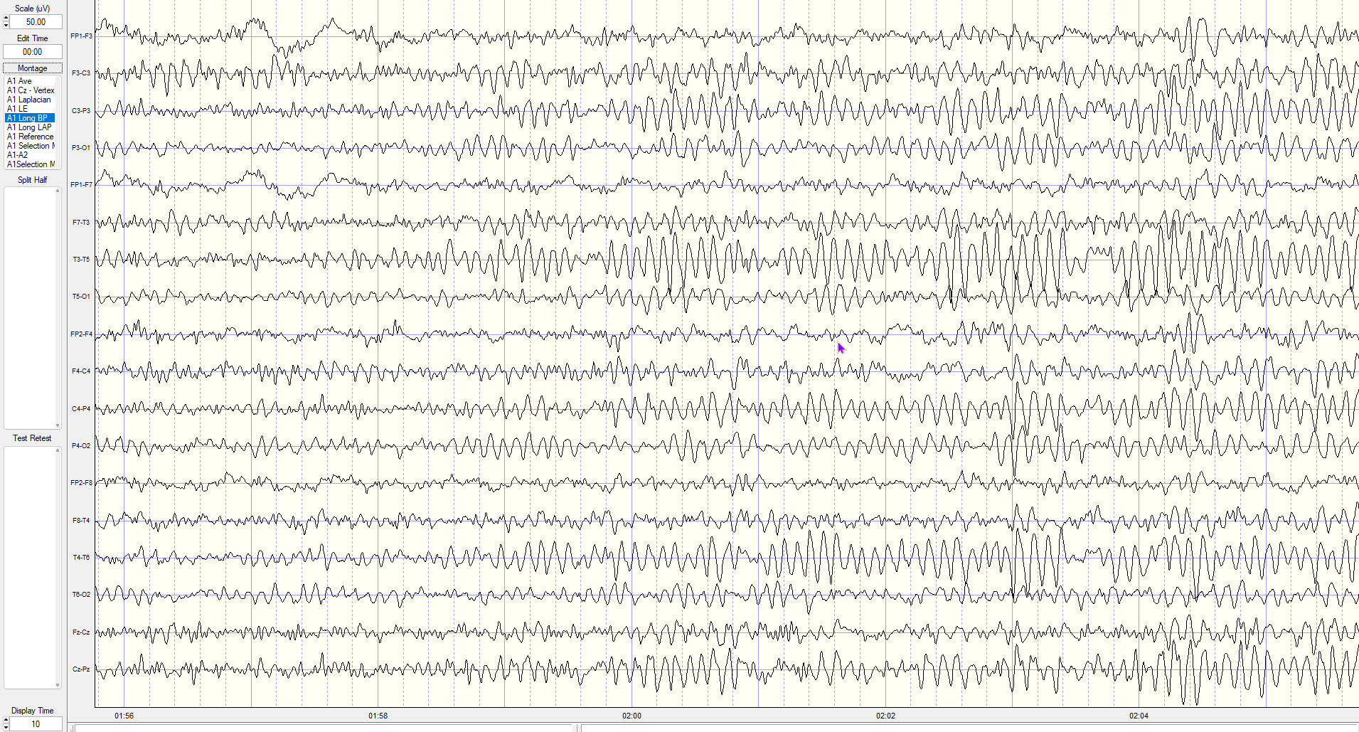 Synchronized EEG tracing