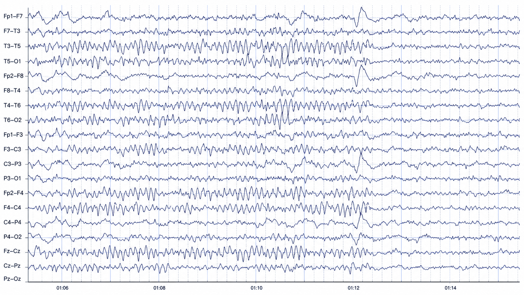 Full scalp EEG in longitudinal montage showing widespread rhythmic theta with a spindle-like burst and a sharp central transient