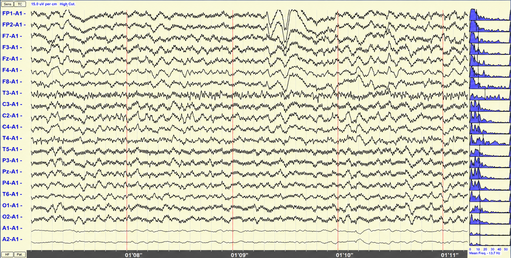 50/60 Hz artifact