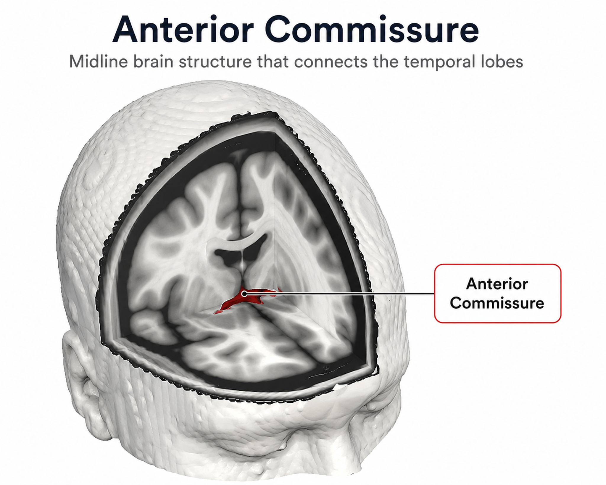 Diffusion tensor image of the anterior commissure
