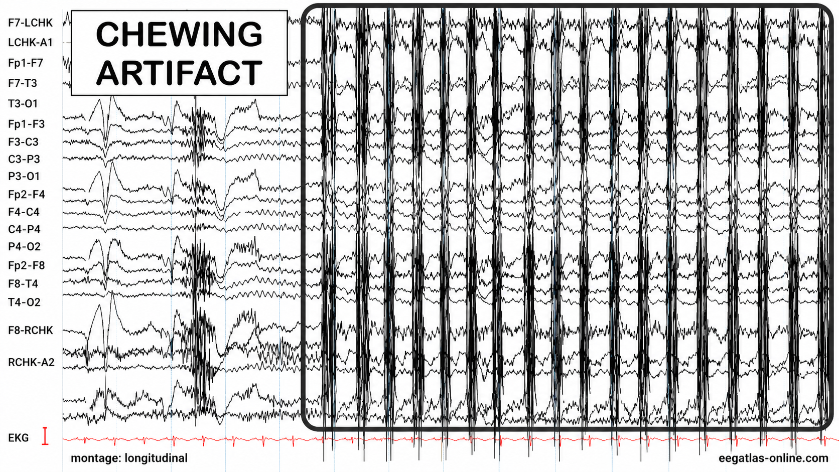 Chewing artifact in EEG