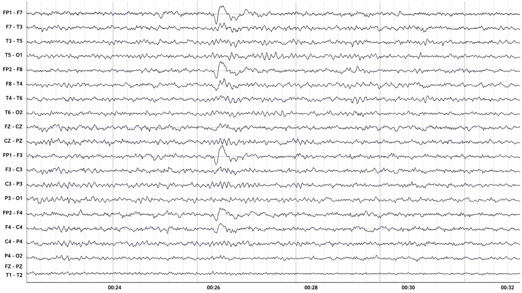 Eyes-open EEG showing a low-voltage mixed background interrupted by a frontally maximal bilateral eye-blink transient