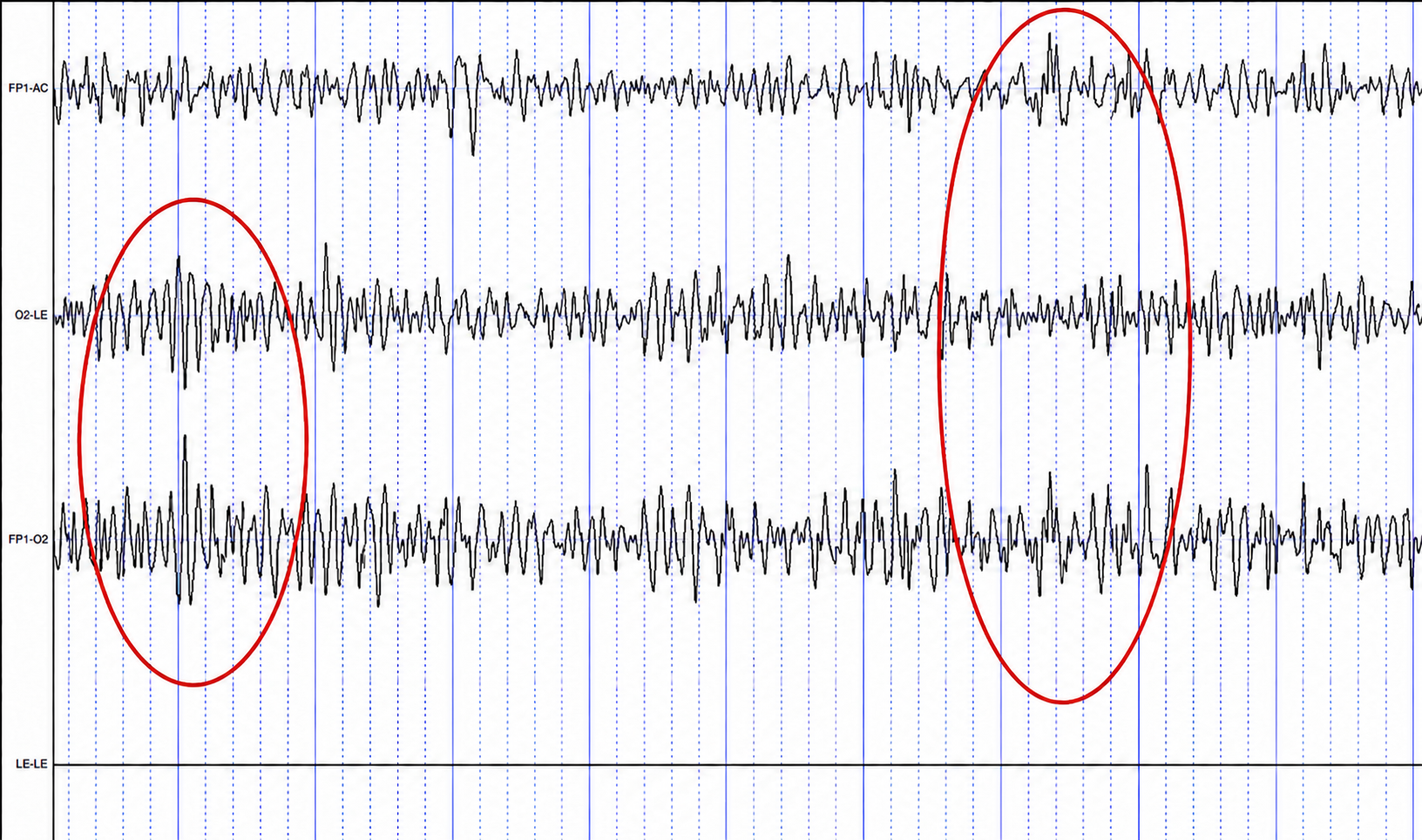 Common mode rejection example
