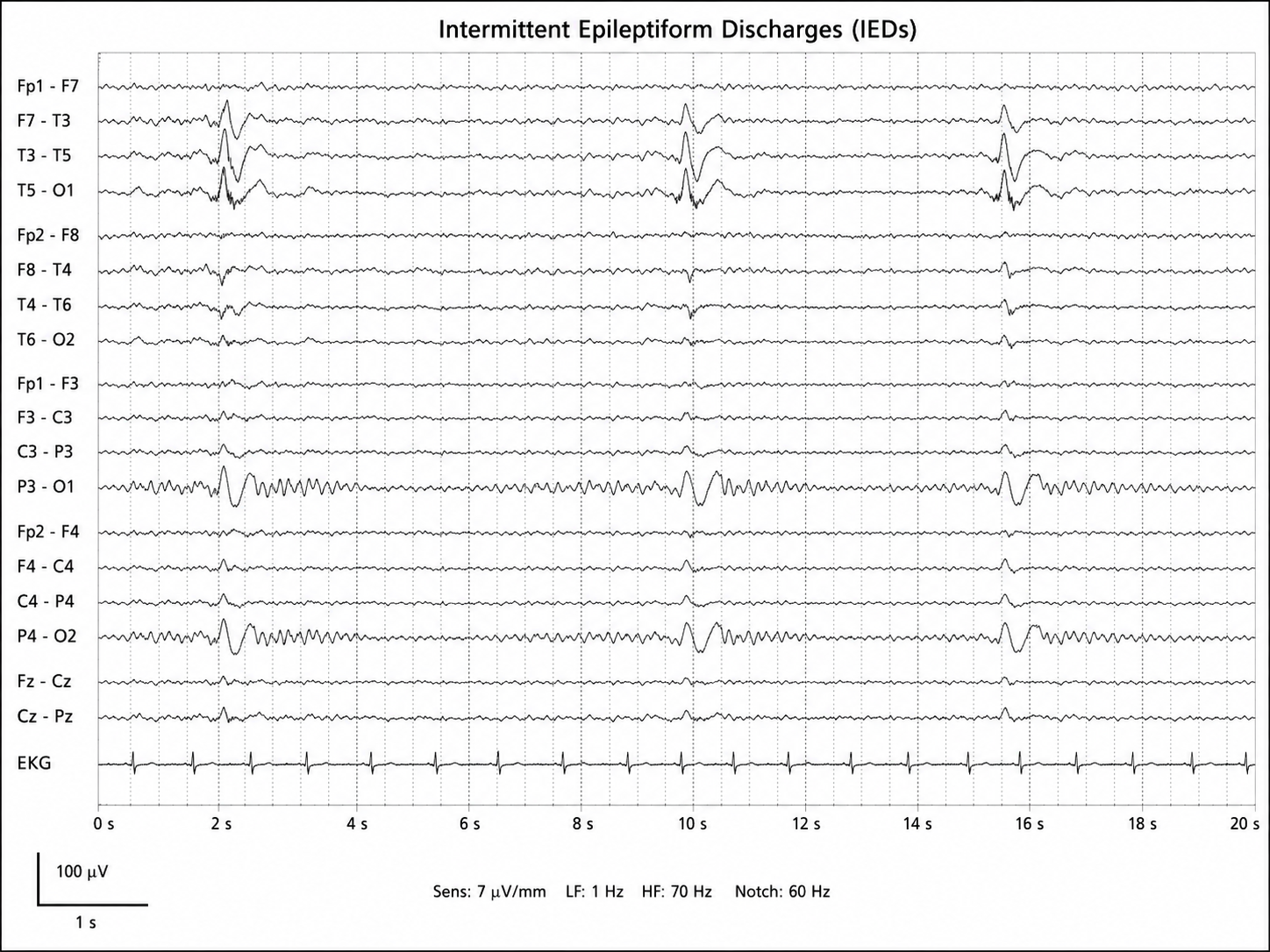EEG showing intermittent focal epileptiform discharges over the left temporal region