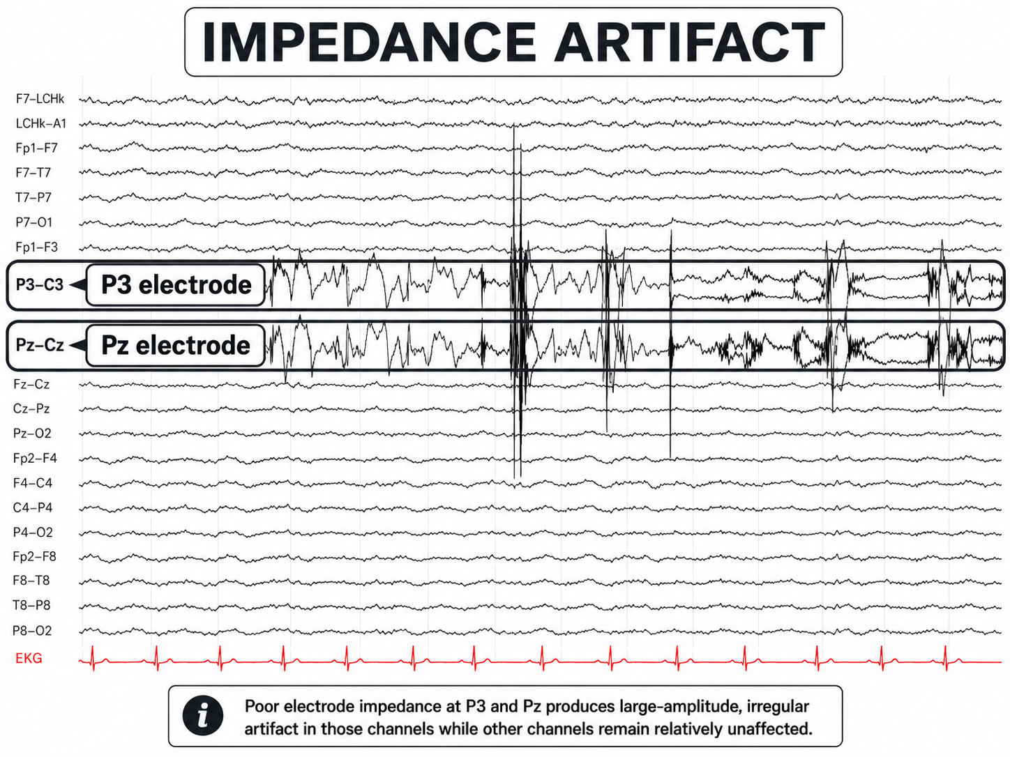 Impedance artifact