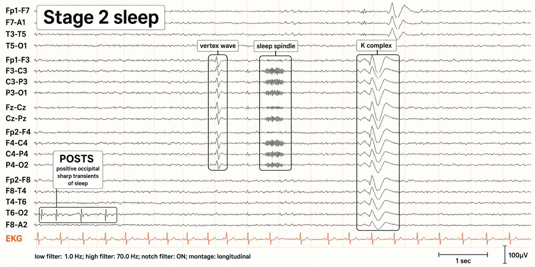 Stage 2 sleep tracing with POSTS, a vertex wave, a sleep spindle, and a K complex labeled