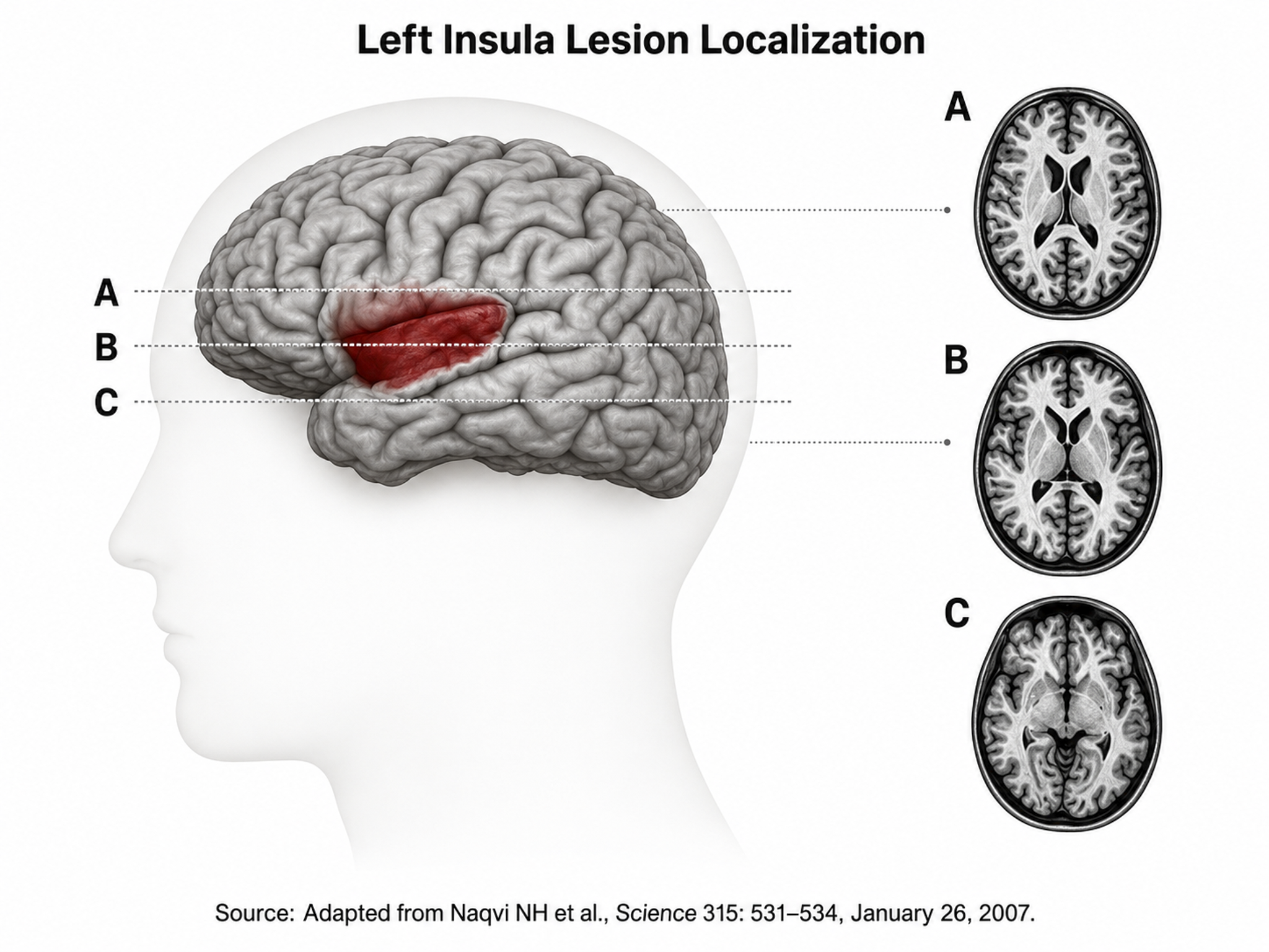 Left cortical surface with the insular region indicated