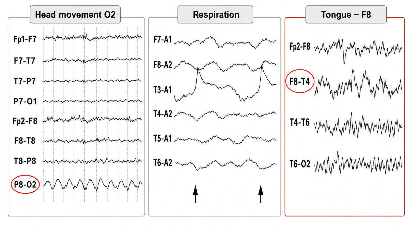 Movement artifacts from head, respiration, and tongue