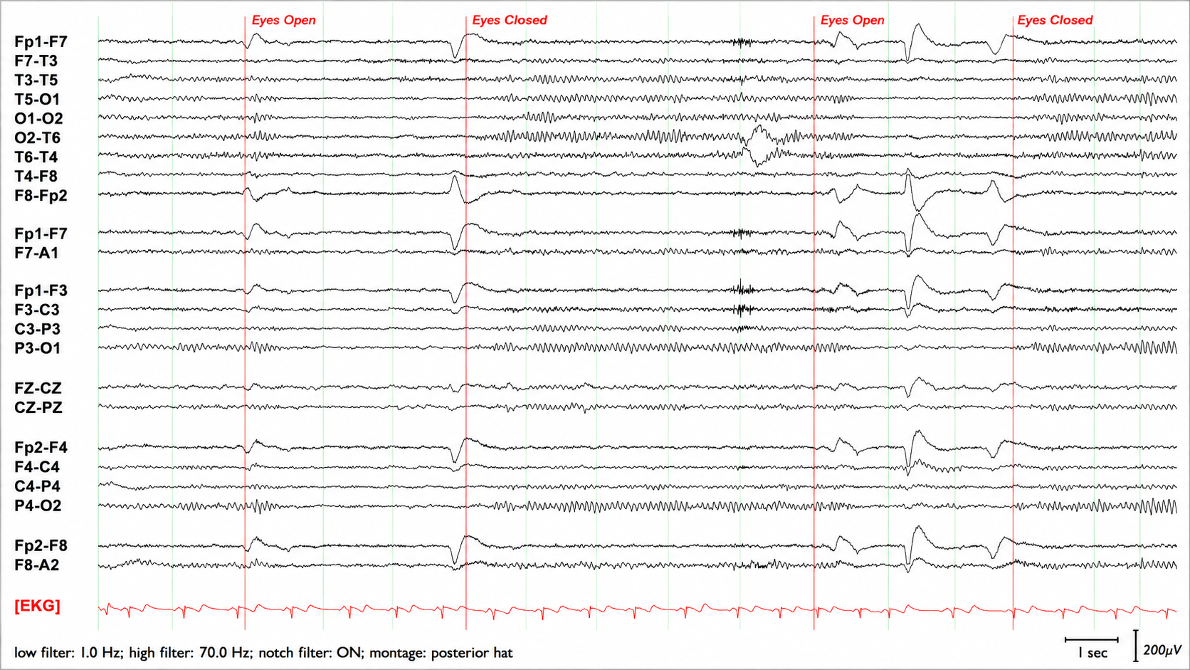 PDR at P3-O1