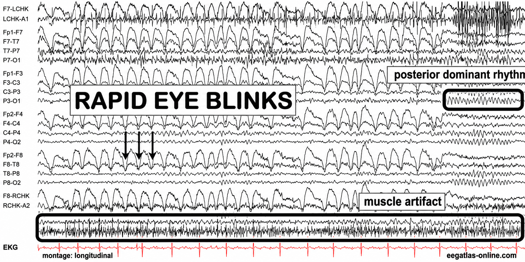 Rapid blinking artifact 2