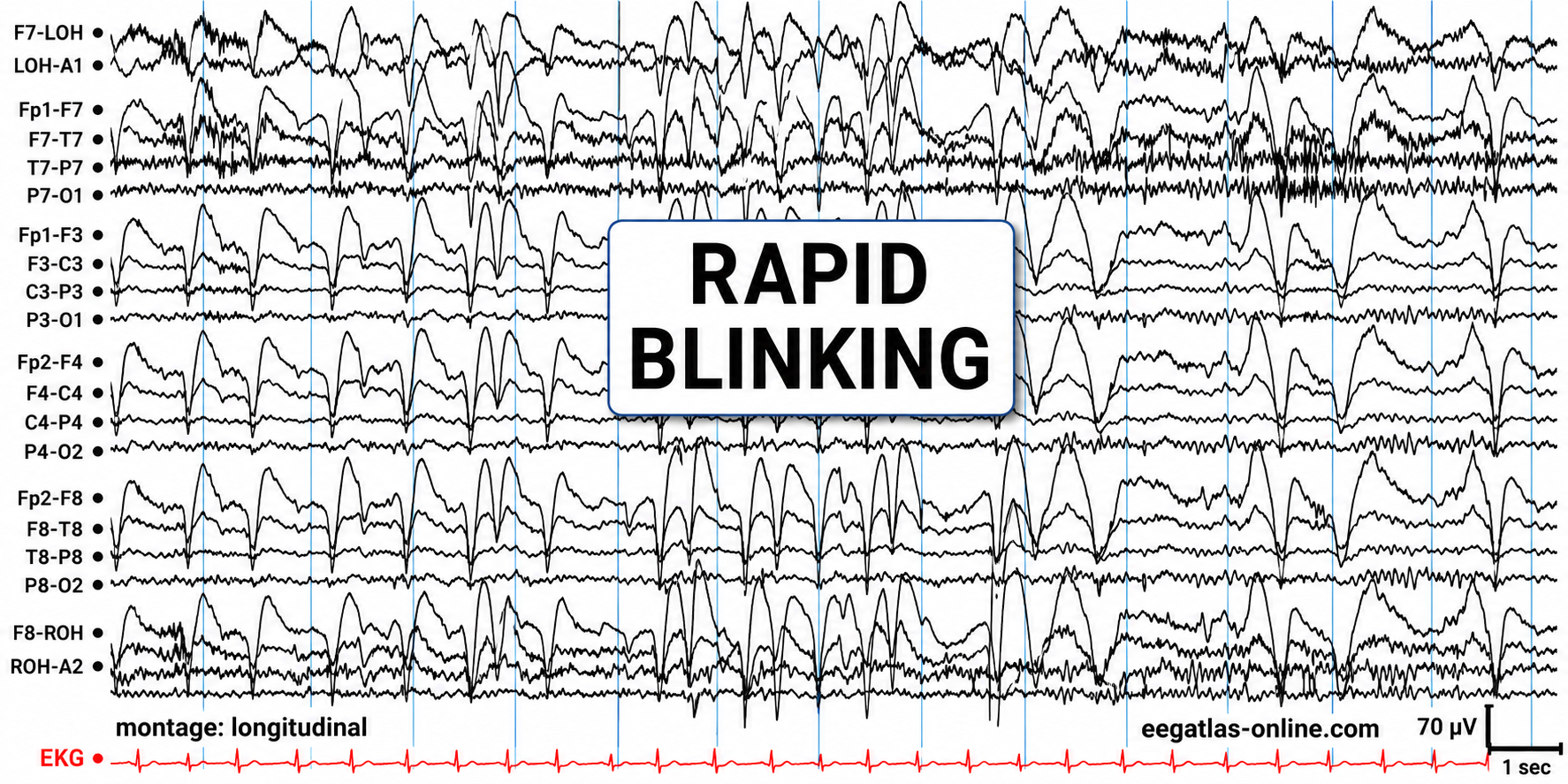 Rapid blinking artifact