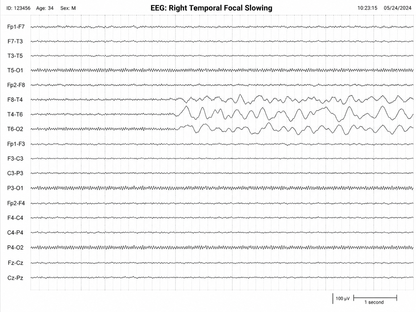 Longitudinal bipolar EEG montage showing intermittent polymorphic delta slowing over the right temporal region