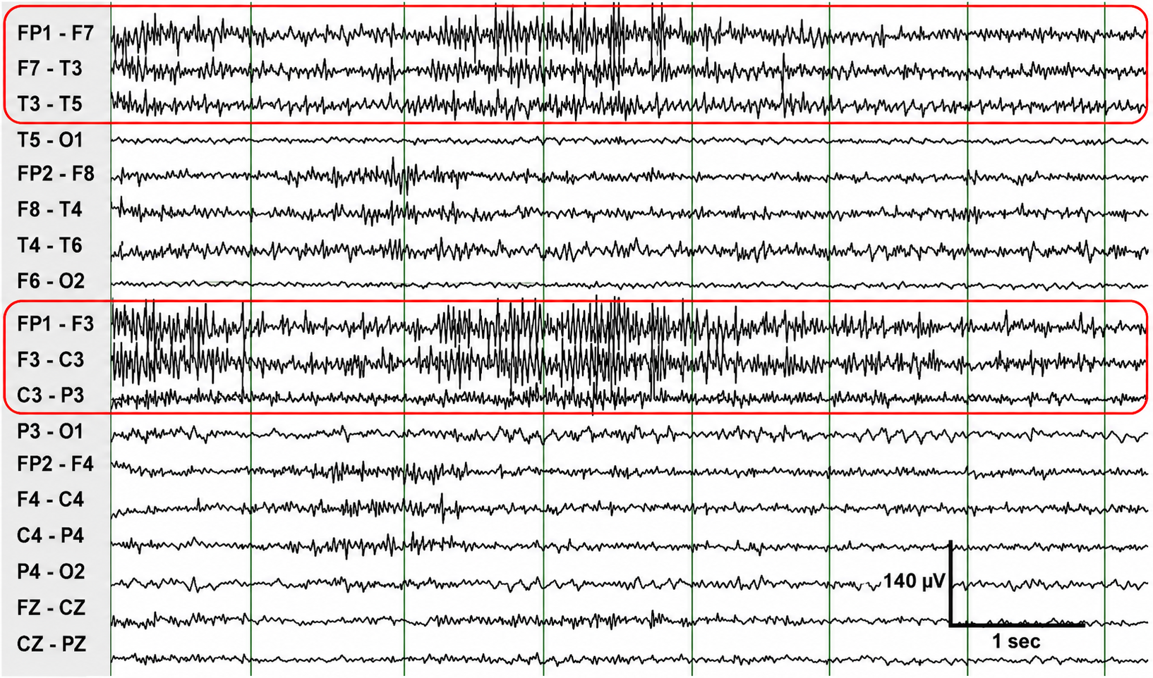 SEMG artifact with 70-Hz HFF