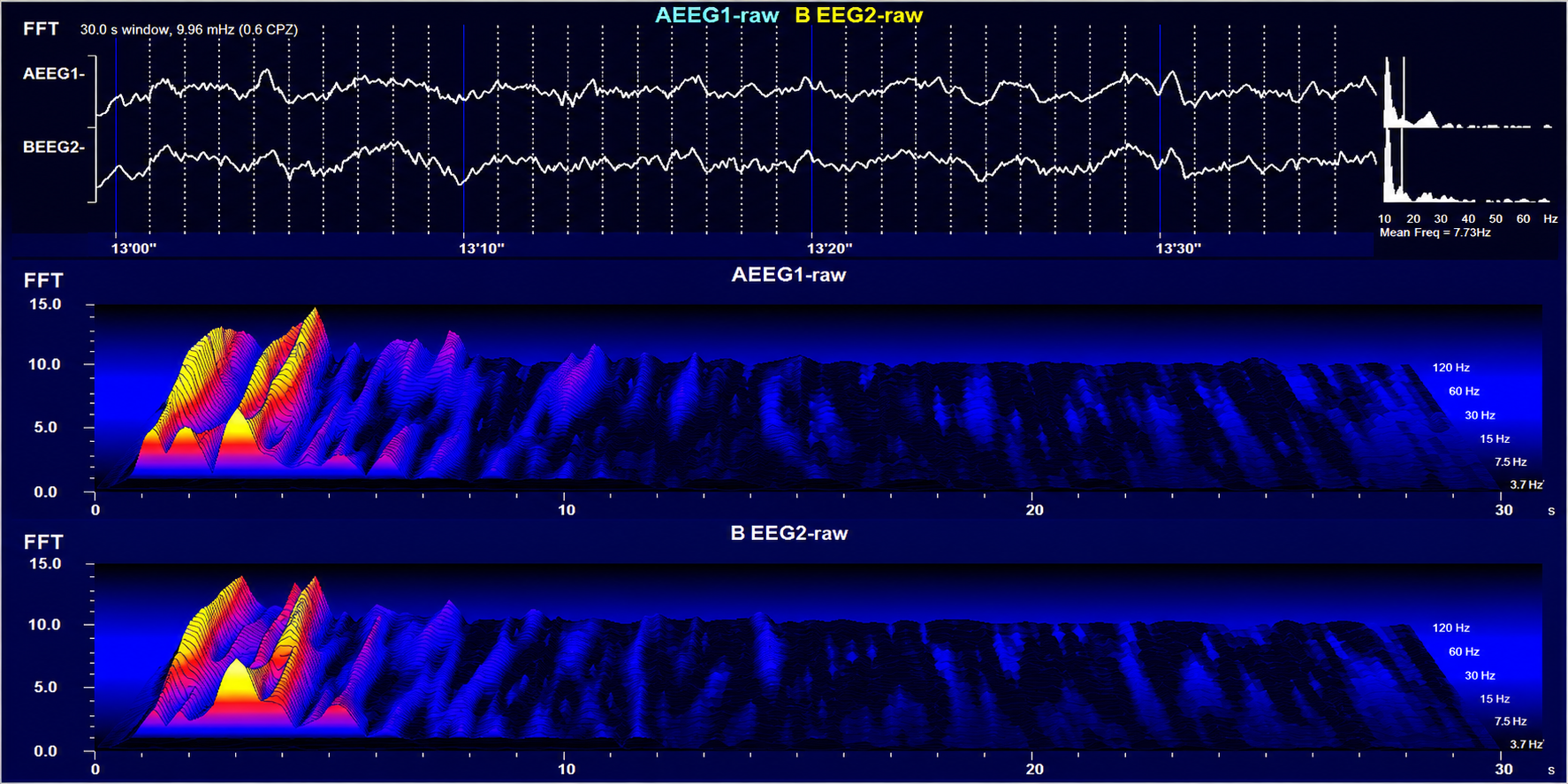 Stage 1 sleep in a two-channel display with waterfall spectrograms
