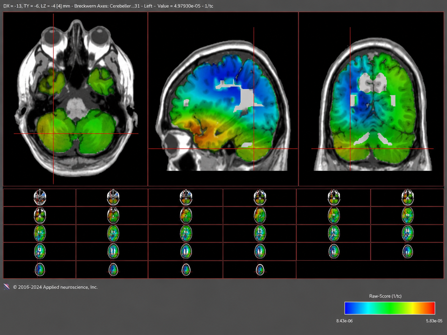 swLORETA brain mapping