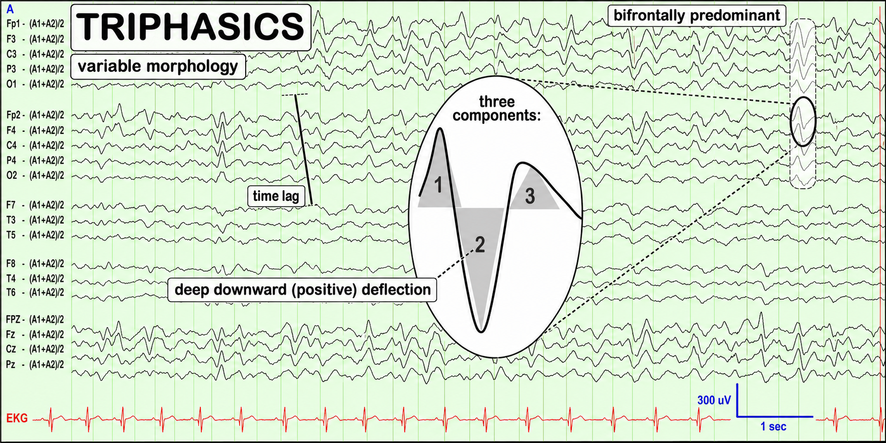 Referential EEG montage showing generalized bilaterally synchronous triphasic wave complexes